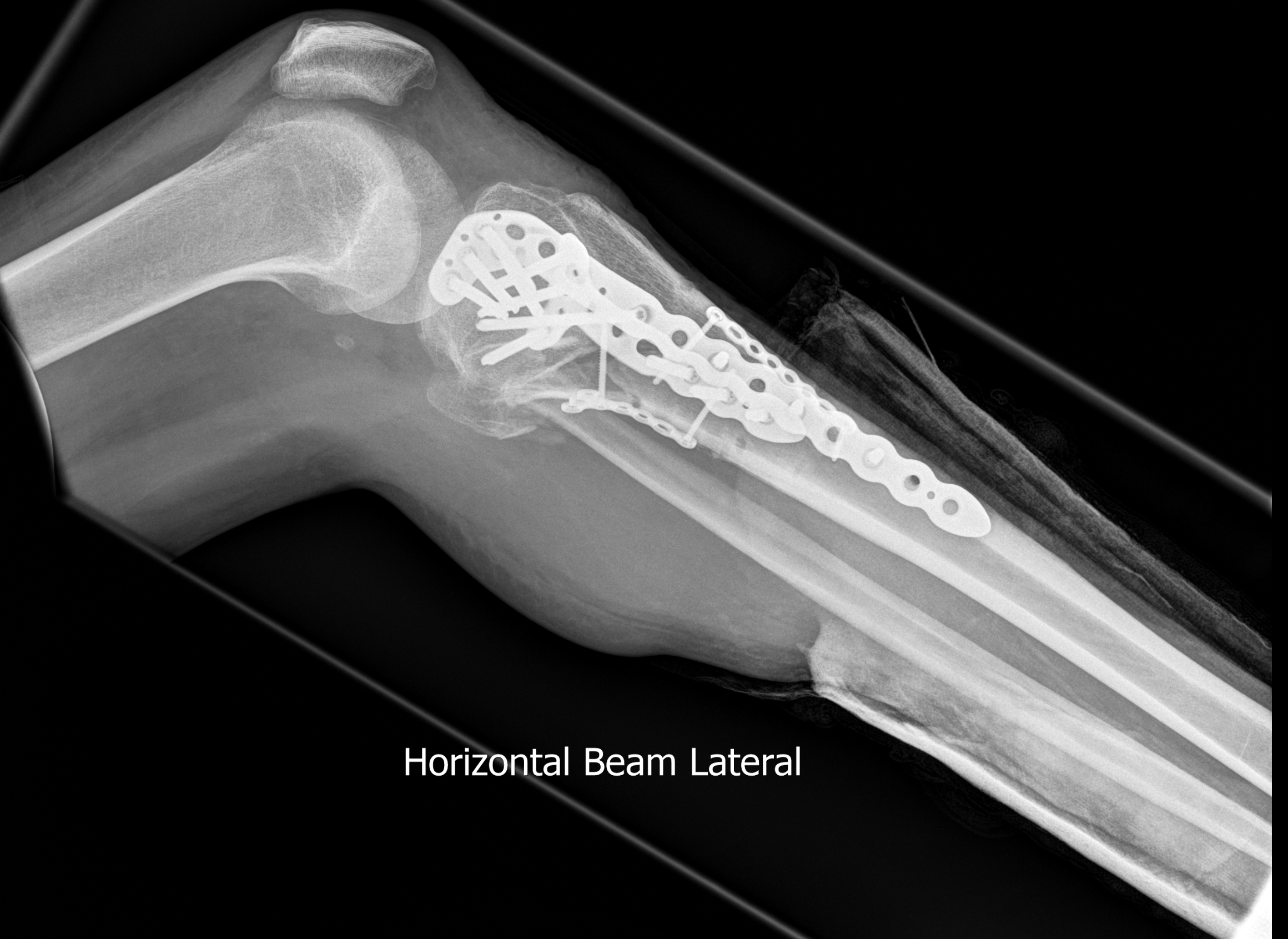 A x-ray image showing a leg below with significant surgical work